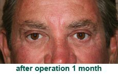 plastic-surgery-blepharoplasty
